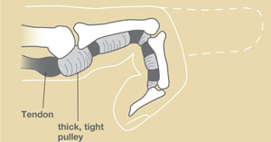 Trigger Finger: Causes, Symptoms, & Treatment