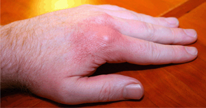 Gout in Hands: Symptoms and Treatment | The Hand Society
