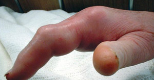 Throbbing thumb swollen Woman with