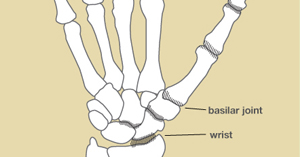 Artrosis de la mano - Osteoarthritis