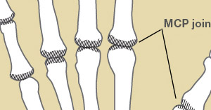 Rheumatoid Arthritis Signs Treatment The Hand Society