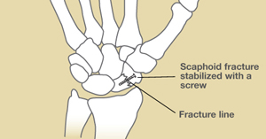 scaphoid fracture cast time