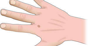 Warts on hands all of a sudden - Do warts on hands hurt