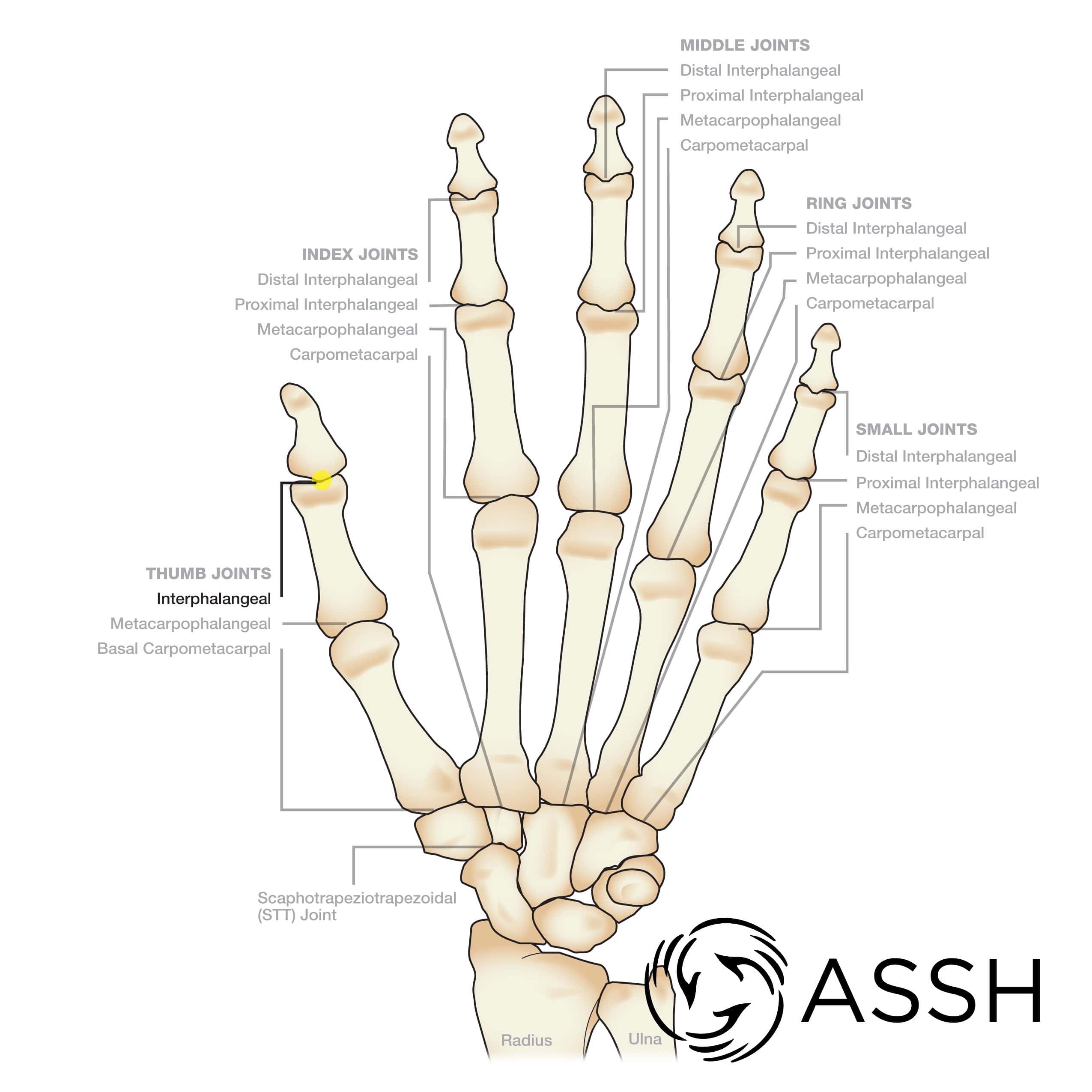 DIP Joint Osteoarthritis: How to Treat this Common Form of Arthritis