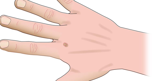 4 Common Types of Hand Tumors