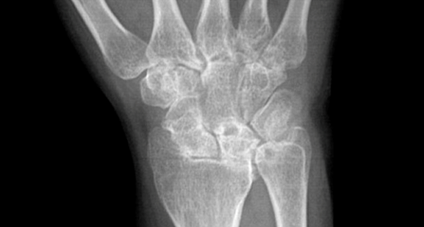 Wrist Arthritis: Symptoms and Treatment - The Hand Society