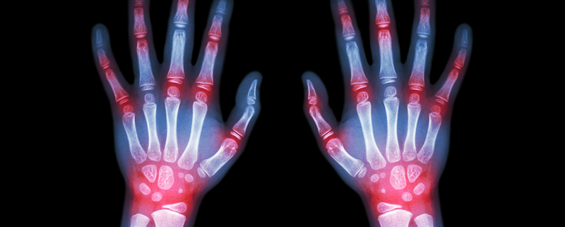 gout vs pseudogout crystals