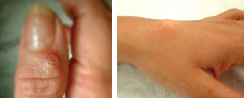 How to Know If You Have a Ganglion Cyst