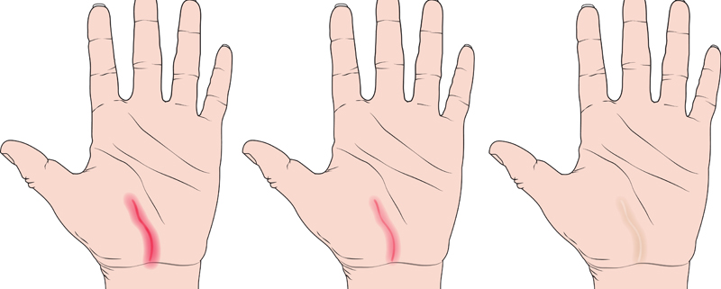 Advice from a Certified Hand Therapist: Scar Management