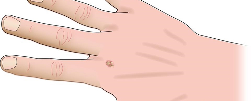 5 things to know about warts