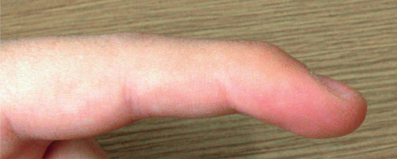 Ask a Doctor: Mallet Finger