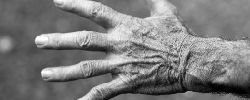 5 Signs of Psoriatic Arthritis