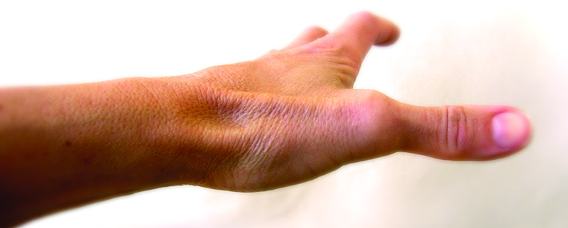 Help for Thumb and Wrist Tendonitis