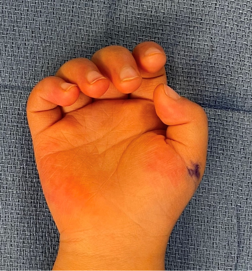 Congenital Trigger Thumb What Is It? Symptoms, Causes, and Treatment