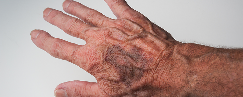 Advice from a Certified Hand Therapist: How to Manage a Bruised Hand