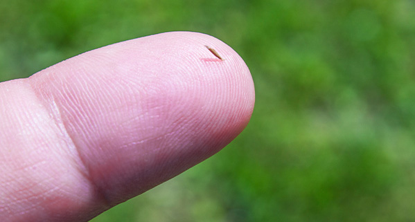 Ask a Doctor: Splinters, Slivers, and Foreign Bodies